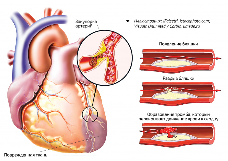 Разрез артерии; схема образования и развития тромба