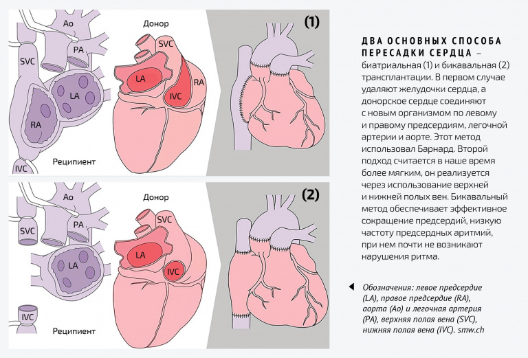 два основных способа пересадки сердца: биатриальная и бикавальная