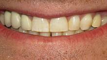  Ученые изучили, почему избыток фтора окрашивает зубную эмаль