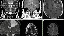 Новый препарат против рака мозга прошёл первые клинические испытания