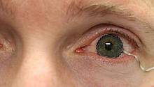 Мягкие контактные линзы – новый способ мониторинга заболеваний глаз  