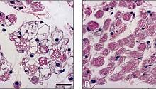 Найден самый эффективный препарат для лечения редкого заболевания мышц