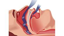 Обструктивное апноэ сна ускоряет старение организма
