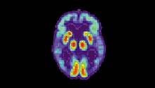 Искусственный интеллект научился предсказывать болезнь Альцгеймера за 6 лет до постановки диагноза
