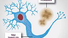 Хиральность тау-белков связана с развитием болезни Альцгеймера