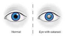 Катаракта может быть связана с риском смерти от заболеваний сосудов