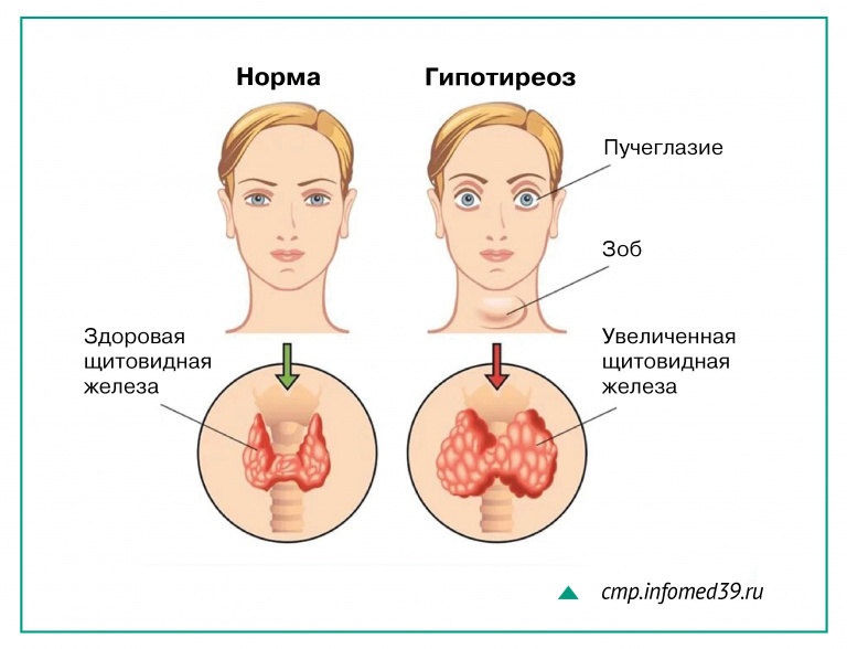 Фторсодержащие соединения накапливаются во внутренних органах, увеличенная щитовидная железа вызывает гипотиреоз