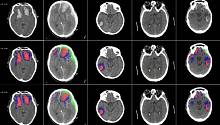 Разработан алгоритм, типологизирующий повреждения мозга