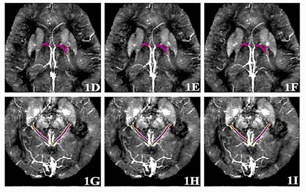 Метод ученых Пермского Политеха позволит диагностировать болезнь Альцгеймера с точностью до 89% на ранних стадиях