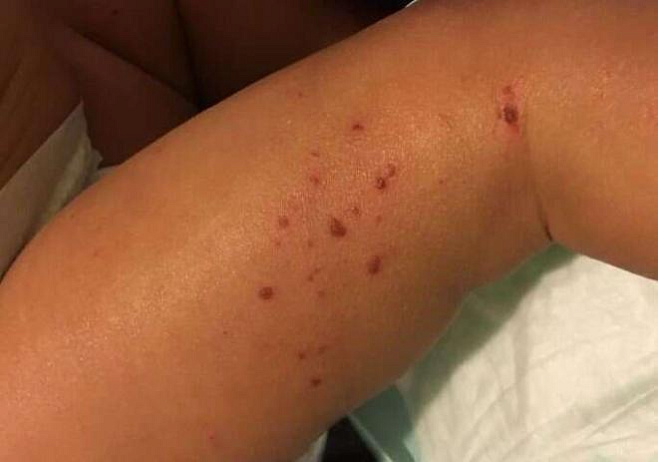 Как две генетические вариации приводят к развитию экземы