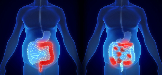 Физические упражнения могут ослабить развитие рака толстого кишечника